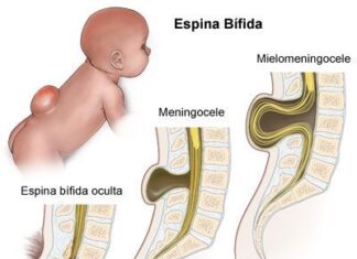 ¿Qué es la espina bífida?