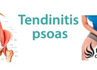 Tendinitis del Músculo iliopsoas y el dolor pélvico Tendinitis del Músculo iliopsoas