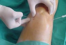 Artrosis y obesidad