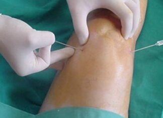 Artrosis y obesidad