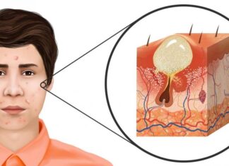 ACNÉ, Cuidado y Tratamiento para Evitar Granos que es el acne