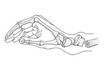 La Fractura de Muñeca