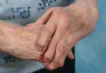 Artritis reumatoide (AR) y Fisioterapia