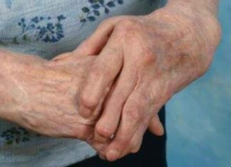Artritis reumatoide (AR) y Fisioterapia