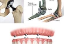 Lección 6: Ortesis y prótesis