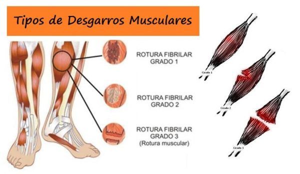 Tipos de Desgarros Musculares