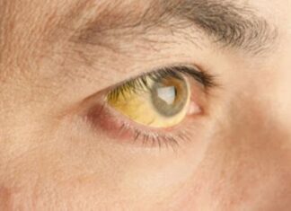 Características de la hepatitis C y relación con fisioterapia