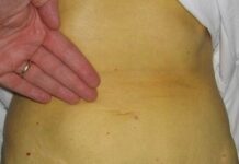 Antes, Hepatitis en la transfusión, riesgos en fisioterapia