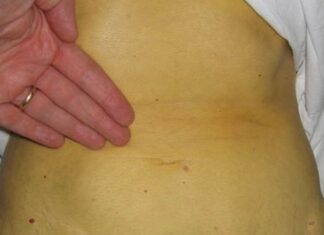 Antes, Hepatitis en la transfusión, riesgos en fisioterapia