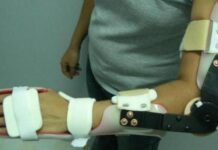 Terapia alternativa: ortesis