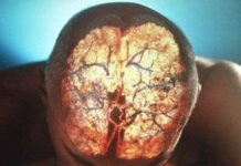Rehabilitación tras un Derrame cerebral (parte 1)