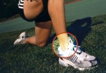 Cómo Curar un Esguince Cómo Curar un Esguince