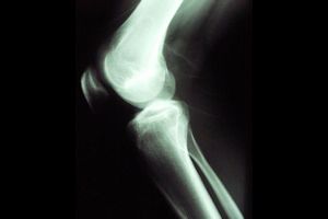 Cómo tratar el síndrome femoropatelar