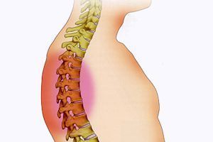 Sabes qué es la dorsalgia