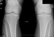 Fisioterapia para Recuperarte Rápido 💪✨ Recuperación viable después de una fractura grave de rótula