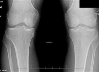 Fisioterapia para Recuperarte Rápido 💪✨ Recuperación viable después de una fractura grave de rótula