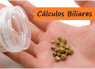 ¿Sabes que son los Cálculos Biliares? calculos biliares