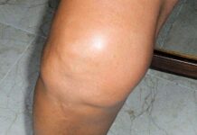 Liquido En La RODILLA