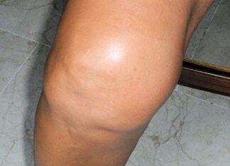 Liquido En La RODILLA