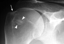 TENDINITIS CALCICA Que Es Y Como Tratarla