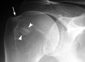 TENDINITIS CALCICA Que Es Y Como Tratarla