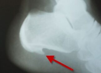 Plantilla para ESPOLONES ¿Qué es el espolón calcáneo?