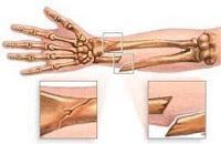 Fractura expuesta 2ª parte