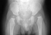 Luxación de la cadera