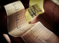 Como prevenir un infarto
