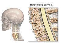 Espondilosis y dolor de espalda