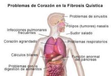 Desarrollo de la fibrosis quística