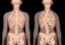 La Escoliosis En Niños Y Adolescentes Y Su Tratamiento