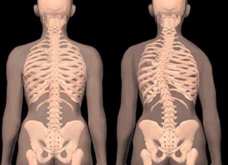 La Escoliosis En Niños Y Adolescentes Y Su Tratamiento