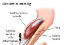 Causas de la tendinitis del tendón de Aquiles