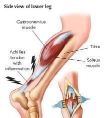 Causas de la tendinitis del tendón de Aquiles