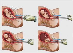 Aborto inducido