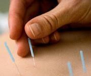 Acupuntura
