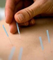 Acupuntura