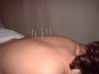 Neuropatía periférica: Terapias alternativas