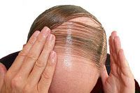 Alopecia