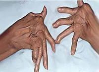 Artritis psoriásica