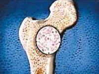 Cáncer de hueso