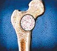 Cáncer de hueso