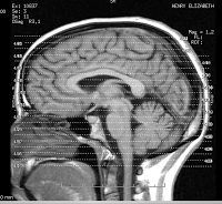 Parkinson