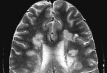 La Esclerosis Múltiple