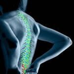 El tratamiento de la ciática por los fisioterapeutas: 1ª parte