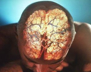 Derrame cerebral