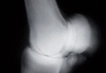 Debilitamiento de la Fisis Femoral Superior