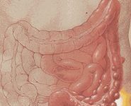 La enfermedad diverticular