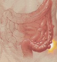 La enfermedad diverticular